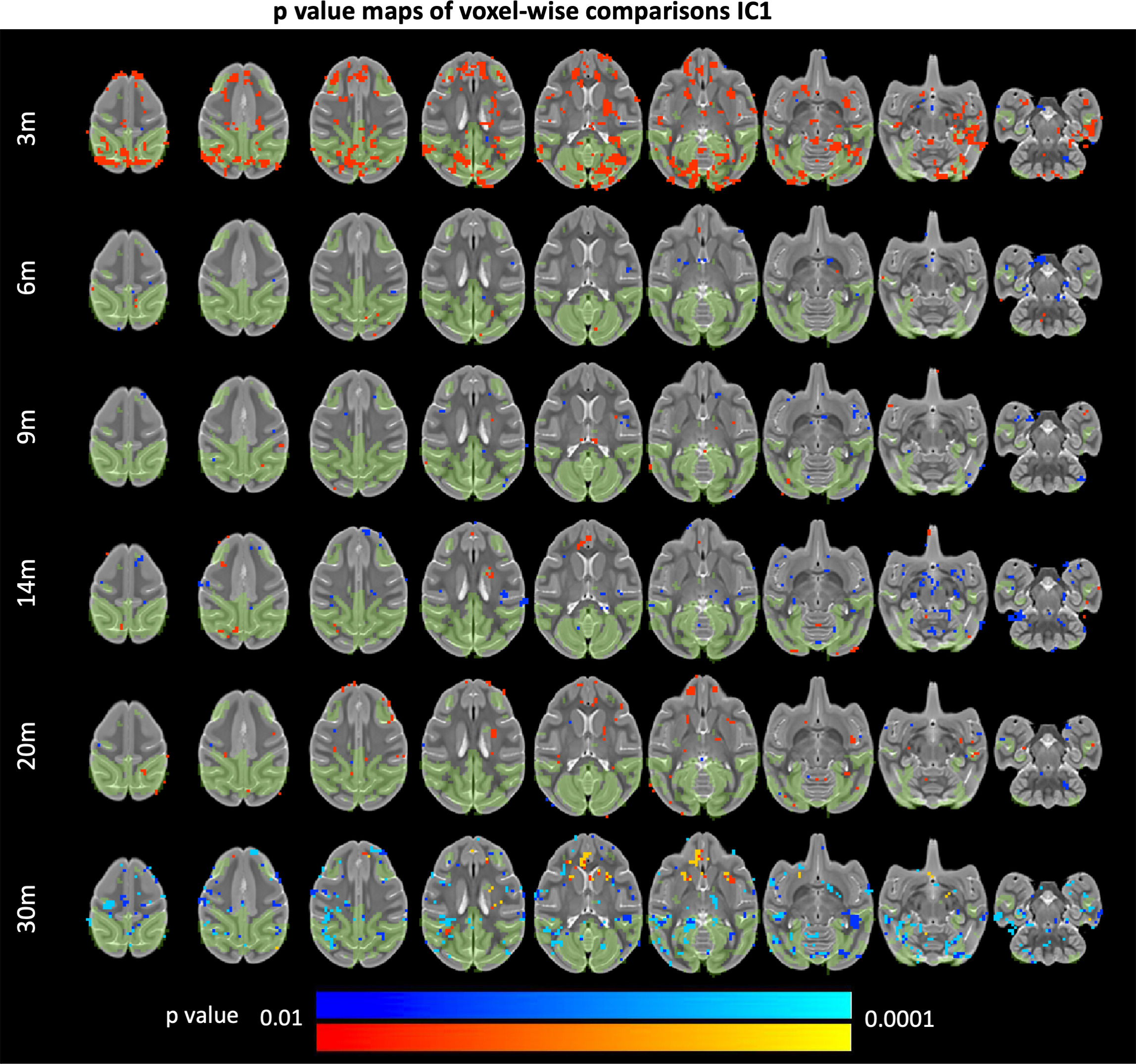 A novel rhesus macaque model of Huntington’s disease recapitulates key ...